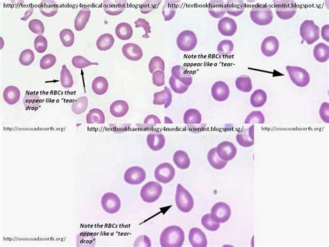 Teardrop cells or Dacrocytes .